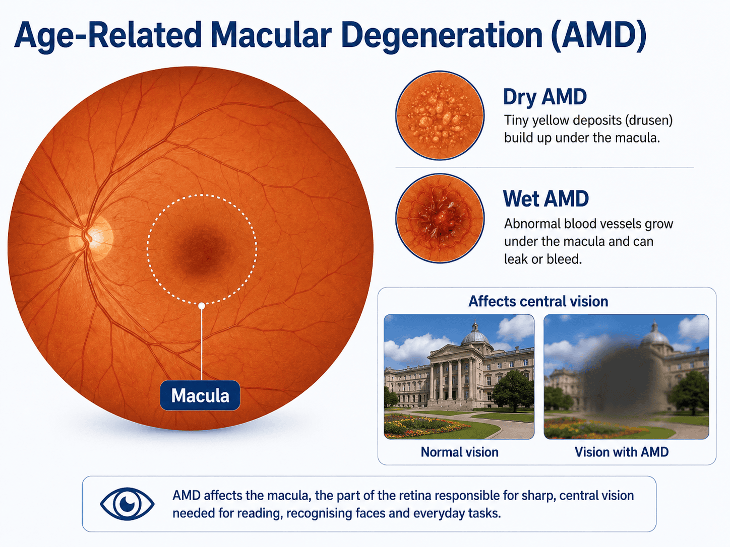 Illustration explaining dry and wet age-related macular degeneration and how AMD affects central vision