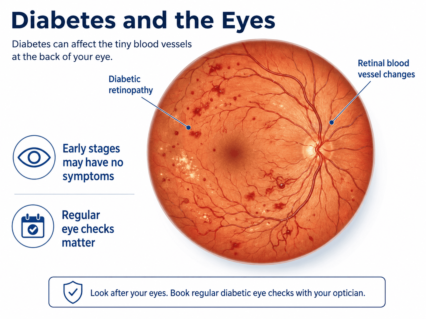 Illustration showing diabetic retinopathy changes in the retinal blood vessels at the back of the eye