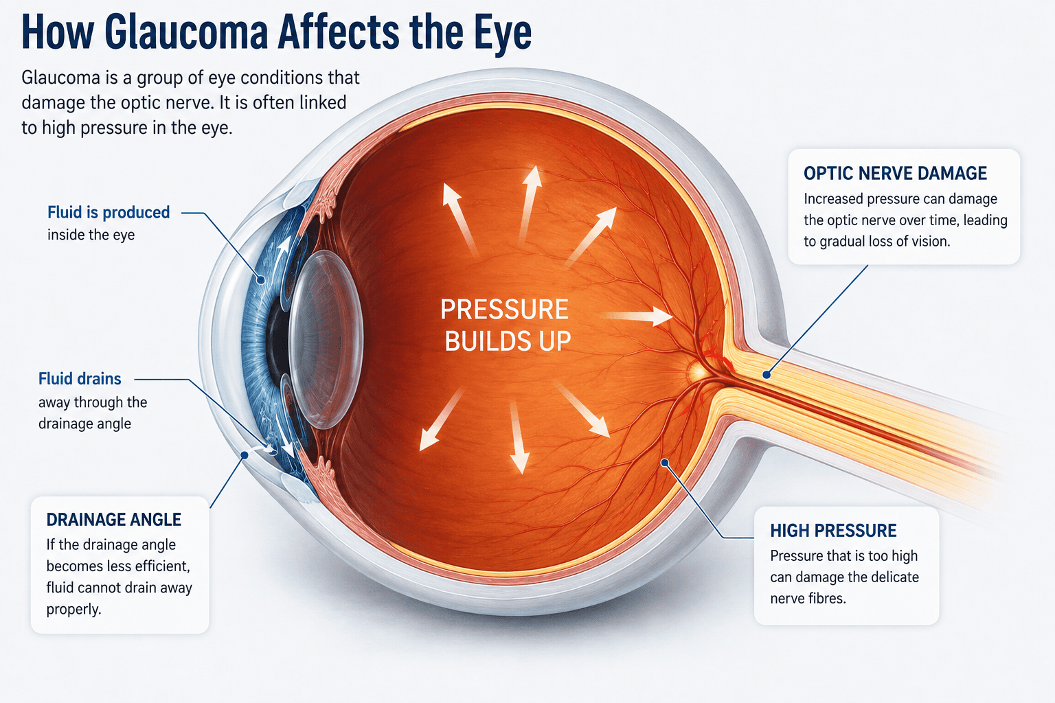 Illustration showing fluid drainage, raised eye pressure and optic nerve damage in glaucoma